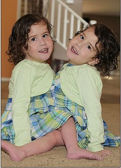 https://www.thesun.co.uk/sol/homepage/news/2886456/Conjoined-twins-share-same-heart.html